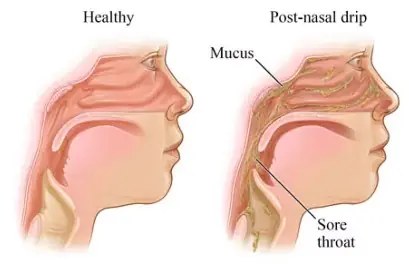 Understanding Mucus: What It Is, What It Means, and How to get rid of it