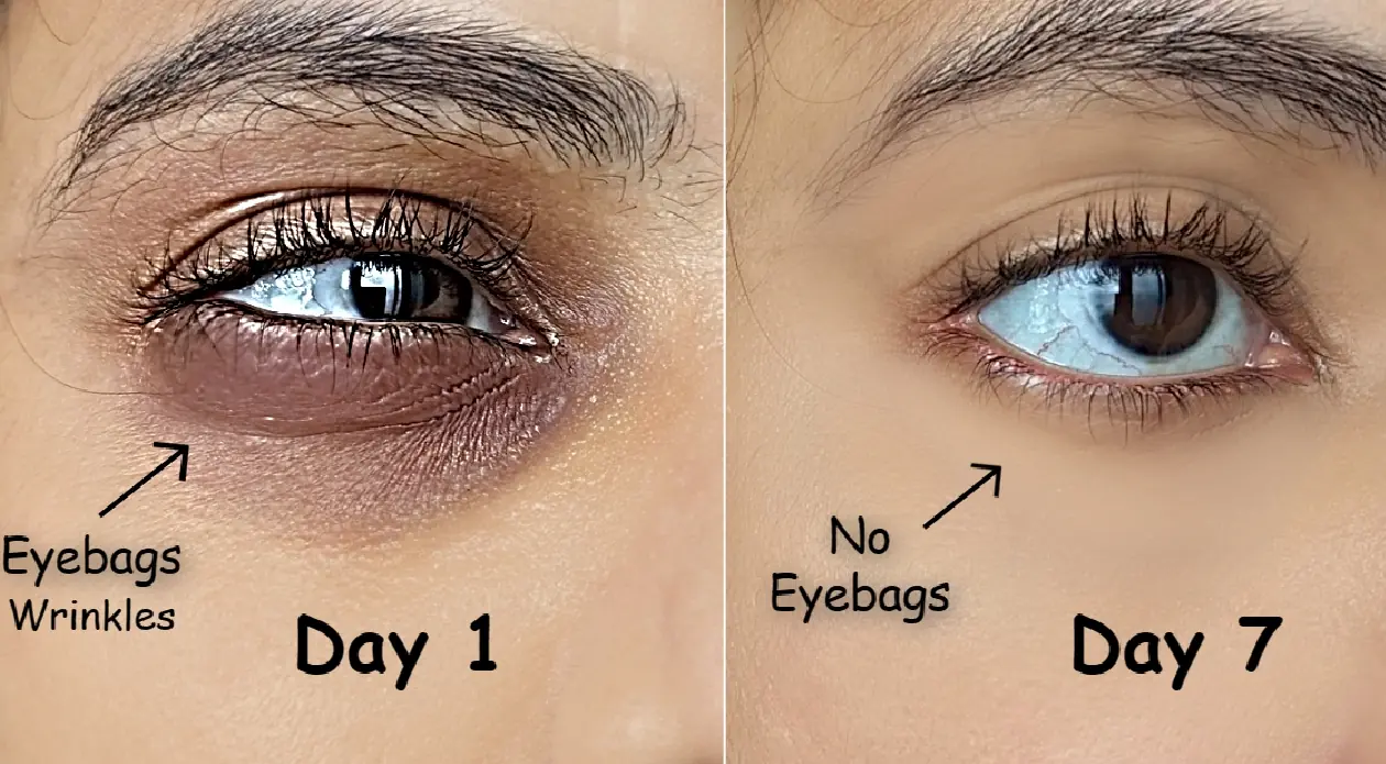 How to Get Rid of Puffy Eyes & Under Eye Bags with the Cold Spoon Method