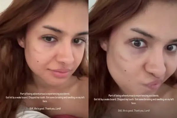 Rabiya Mateo figures in wakeboarding accident, sustains bruises on face
