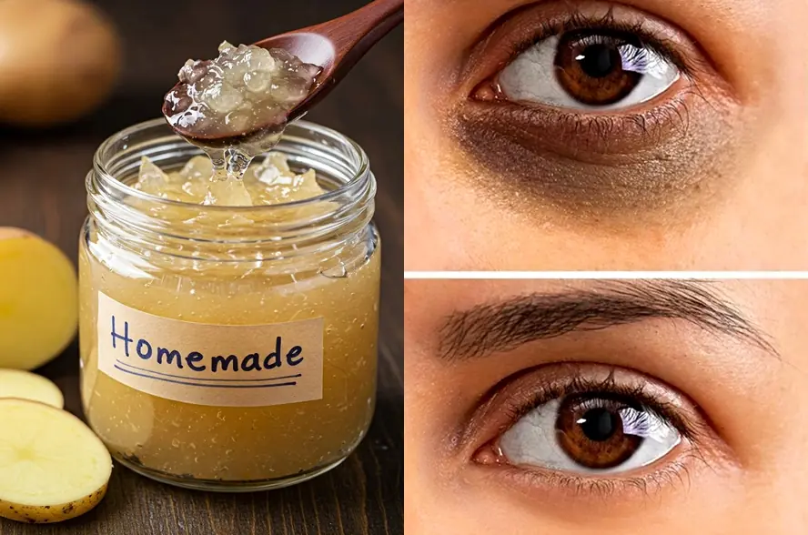 Treat Dark Circles, Sunken Eyes & Puffy Eyes with Home Remedies and Eye Creams