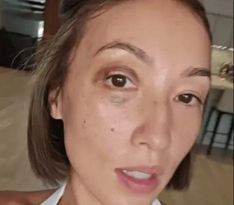 Solenn Heussaff Shows Off her Bl@ck Eye