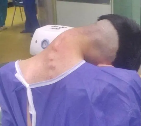 23-Year-Old Man Develops Rare ‘Dropped Head Syndrome’ Following Years of Dru9 Abu$e