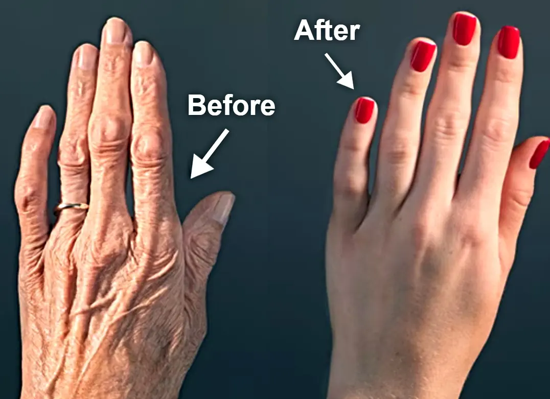 How to Remove Wrinkles from Hands Naturally: The Ultimate Guide to Wrinkle-Free, Youthful Hands at Home