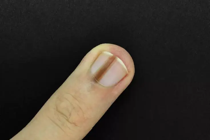 A Dark Line on the Fingernail: A Visual Signal That Should Not Be Ignored