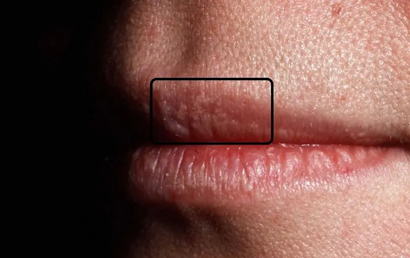 Understanding White Bumps on Lips: Causes, Sympt0ms, and Tre@tment Options