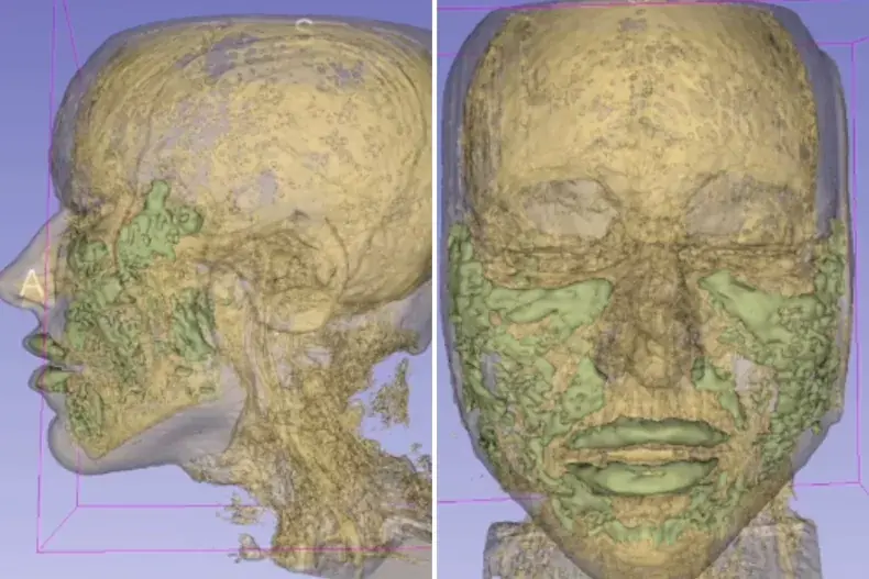 Detailed MRI maps out exactly where a 33-year-old woman's filler ended up in her face
