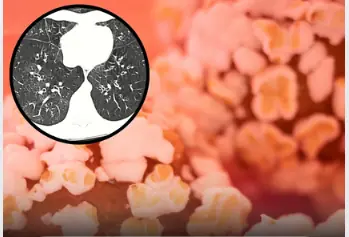 Experts raise alarm on irreversible lung damag3 caused by vap!ng, known as ‘popcorn lung’