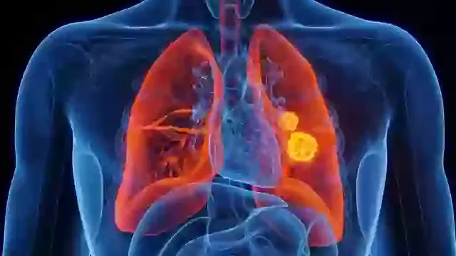 Woman battling stage four colon canc3r reveals major symptom that didn't involve her gut