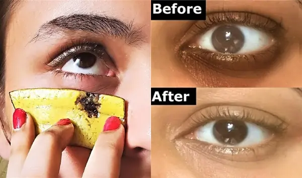 Banana Peel for Dark Circles: A Natural DIY Remedy That Truly Works