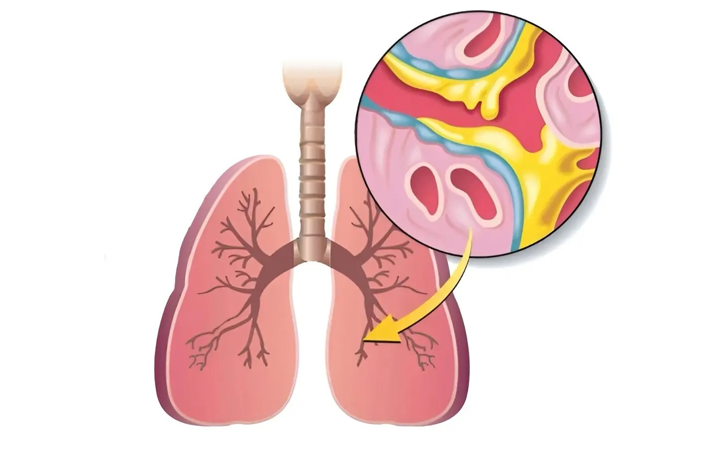 10 Natural Ways to Clear Che$t Congestion and Get Rid of Mucus Fast