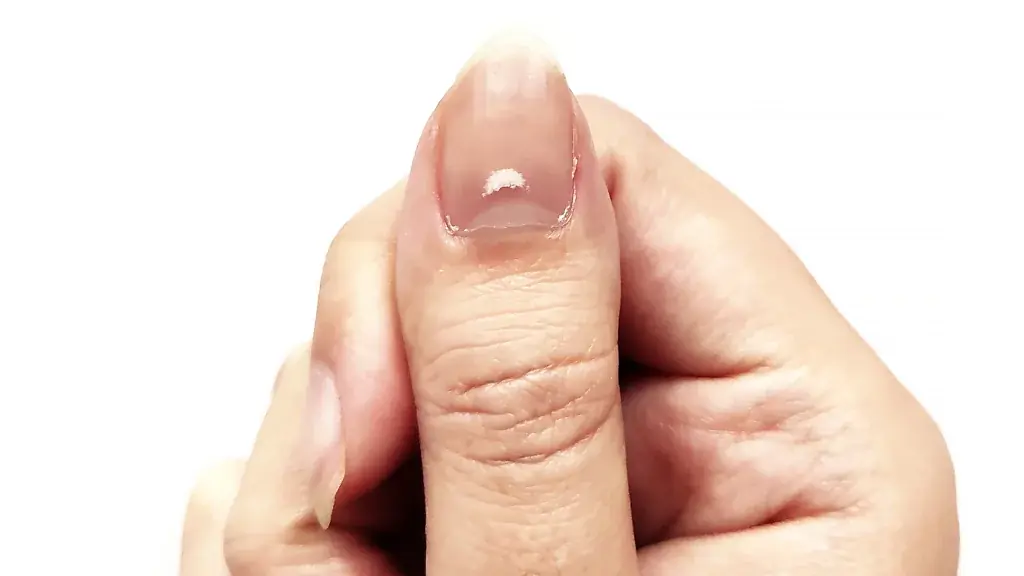 What Your Fingernails Reveal About Your Health: Insights from Experts