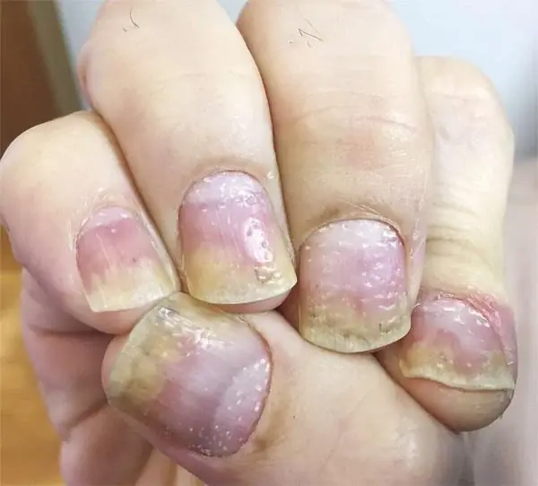 Understanding Nail Pitting in Psoriasis