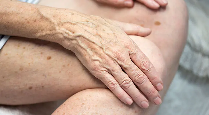 How to Prevent and Reduce Age Spots: Tips for Healthier, Brighter Skin