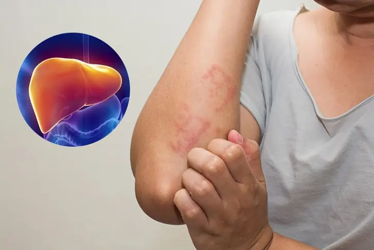 Nurse's 39-Year-Old Battle: Detecting Liver C@ncer Early Through 4 Overlooked Symptoms