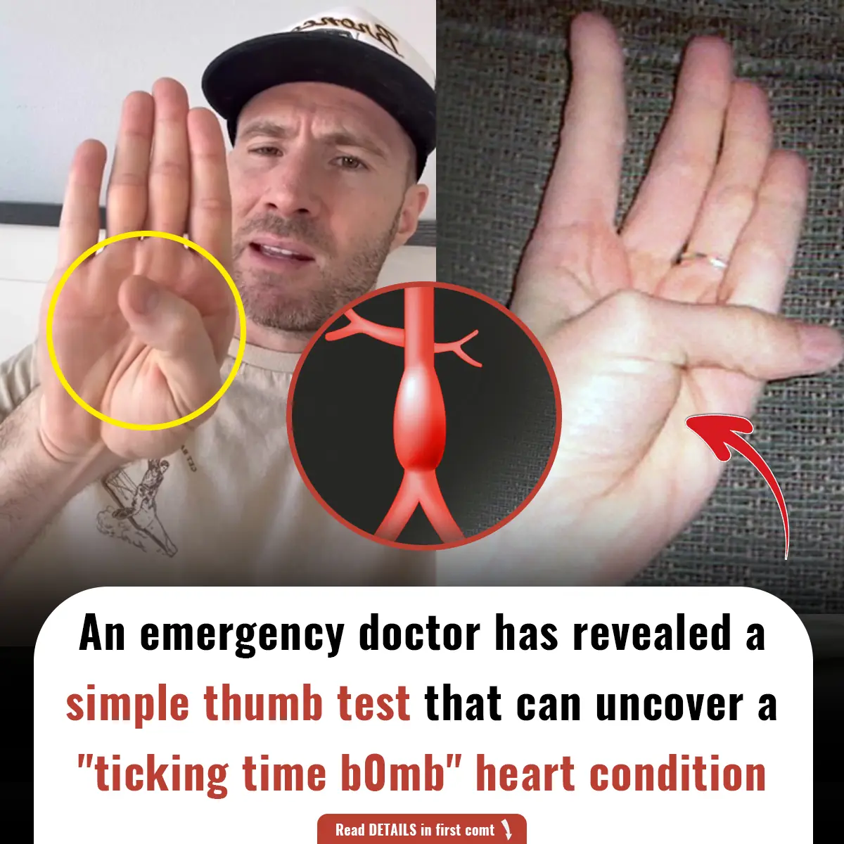 A doctor has revealed a simple thumb test that can uncover a "ticking time b0mb" heart condition