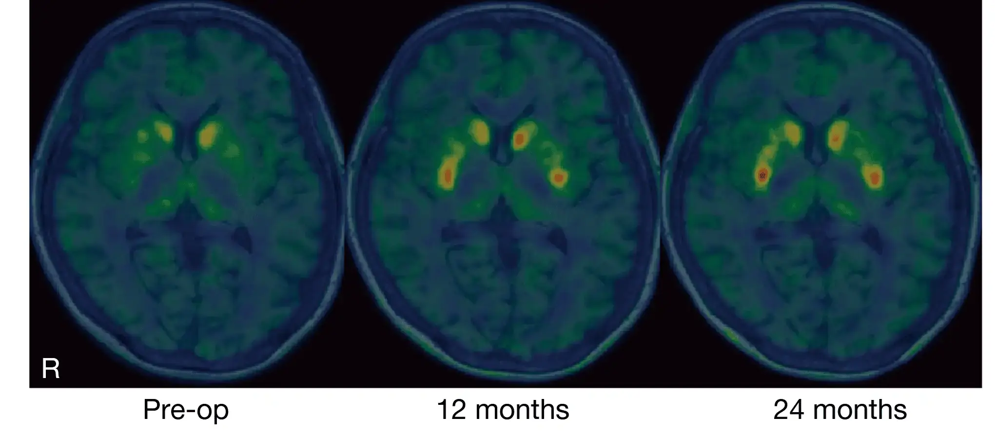 Breakthrough in Parkinson’s Treatment: Japanese Scientists Successfully Implant Lab-Grown Brain Cells