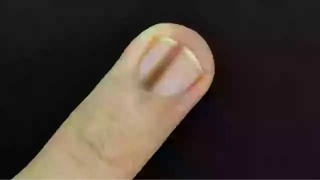 People Warned to See a Doctor After Sharing Photo of Concerning Dark Line on Finger