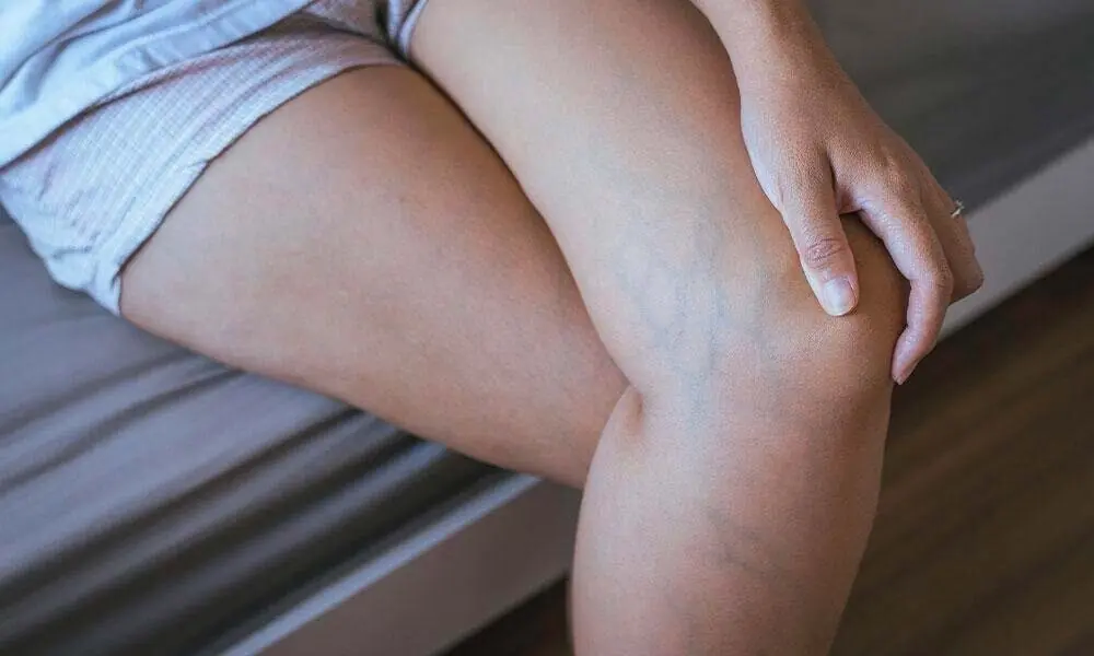 What Causes Blue Veins? Understanding the Reasons and When to Seek Help