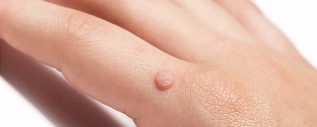 12 Effective Ways to Remove a Wart on Your Finger