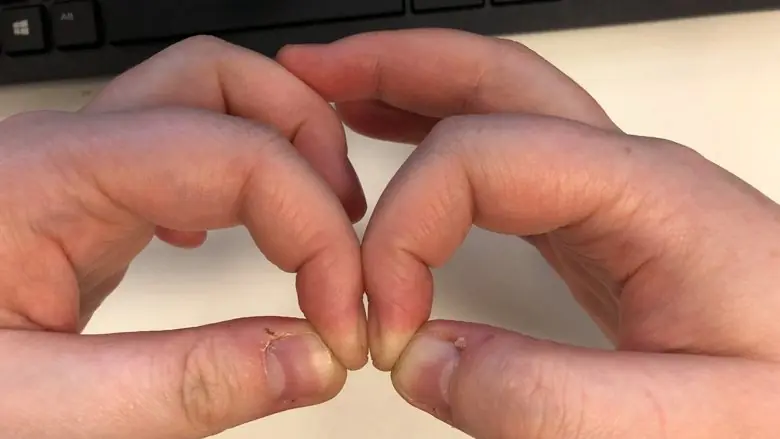 Simple Finger Test Could Reveal Early Signs of Lung C@ncer and Other Health Issues