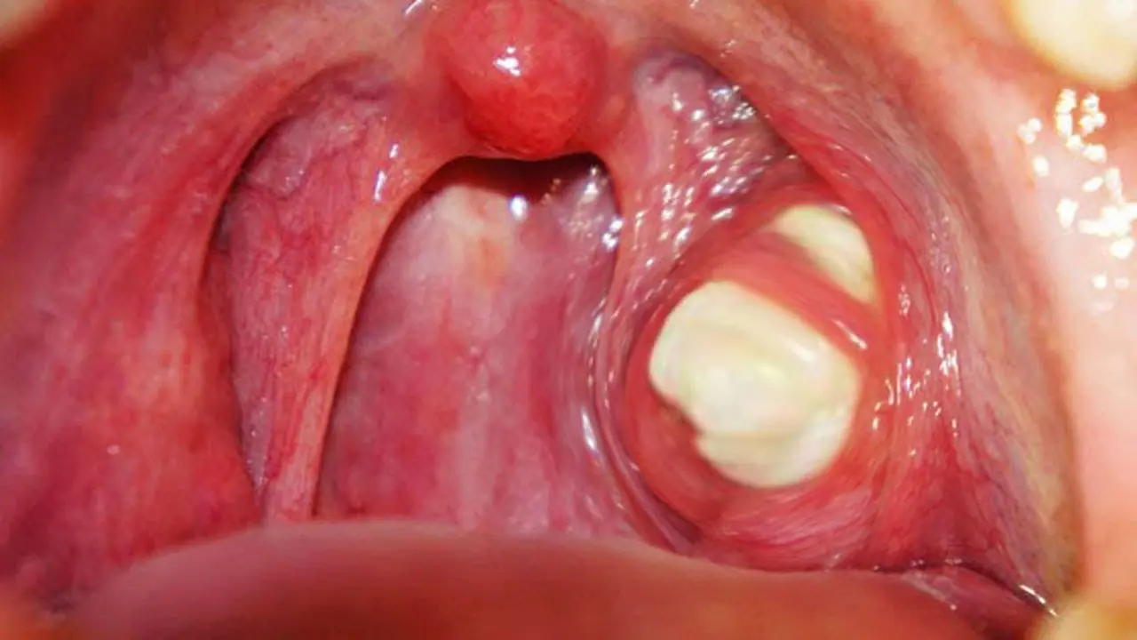 Understanding Tonsil Stones: Symptoms, Causes, Treatment & Prevention Tips