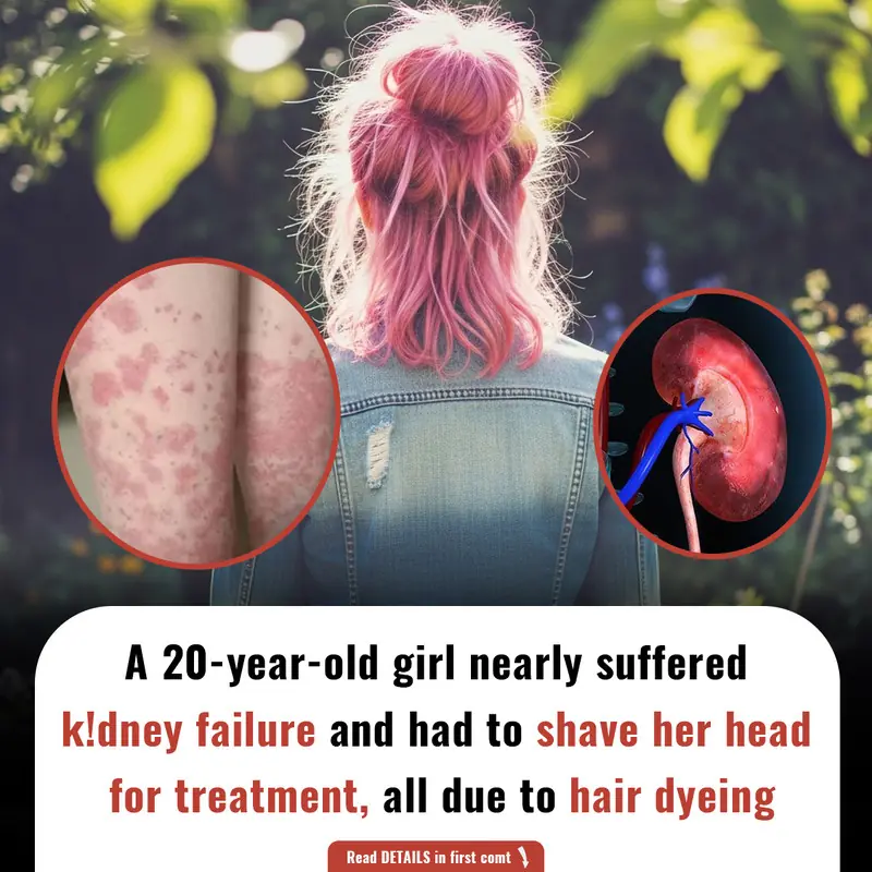 20-Year-Old Woman's Kidney Crisis Linked to Monthly Hair Dye!ng