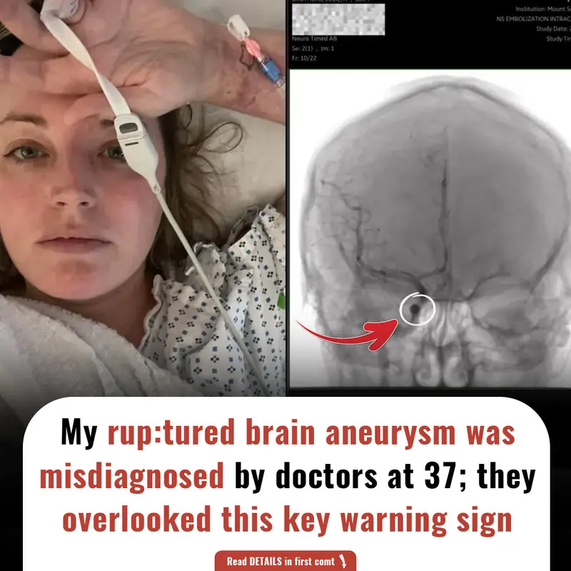 Doctors Misdiagnosed My Ruptured Br@in Aneurysm at 37 — The Key Warning Sign They Overlooked
