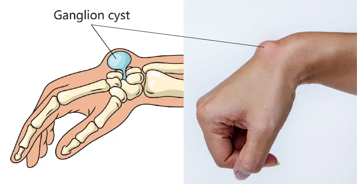 Understanding Ganglion Cysts: Causes, Growth Factors, and Prevention Tips
