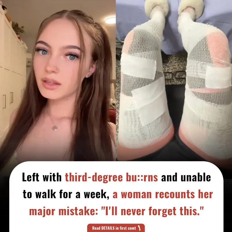 Left with third-degree bu::rns and unable to walk for a week, a woman recounts her major mistake: "I'll never forget this."