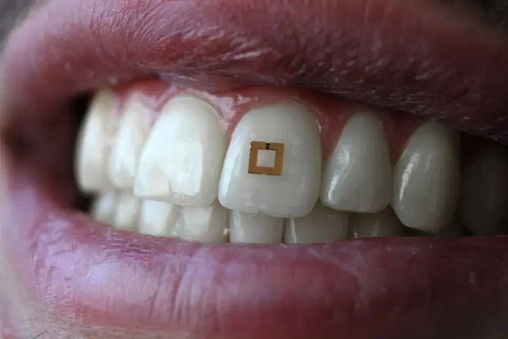 Revolutionary Bioengineered Smart Tooth Implant Promises Natural Integration with Nerves and Gums