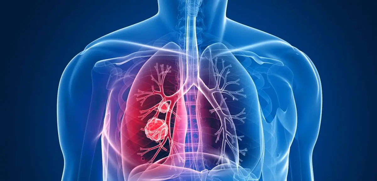 Groundbreaking Lung Canc3r Vaccine BNT116 Entering Clinical Trials: A New Hope for Non-Small Cell Lung Canc3r