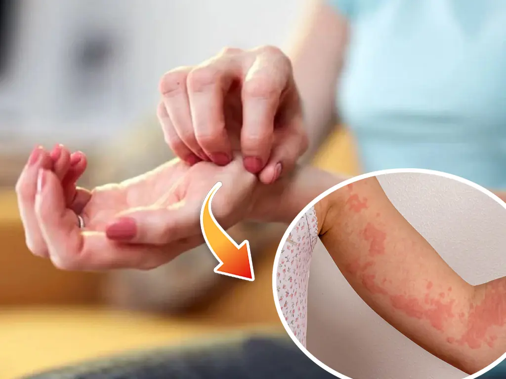 Unexpected Reasons for Hives — What Could Be Causing Your Skin Reaction