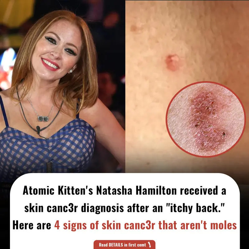Atomic Kitten's Natasha Hamilton received a skin canc3r diagnosis after an "itchy back." Here are 4 signs of skin canc3r that aren't moles