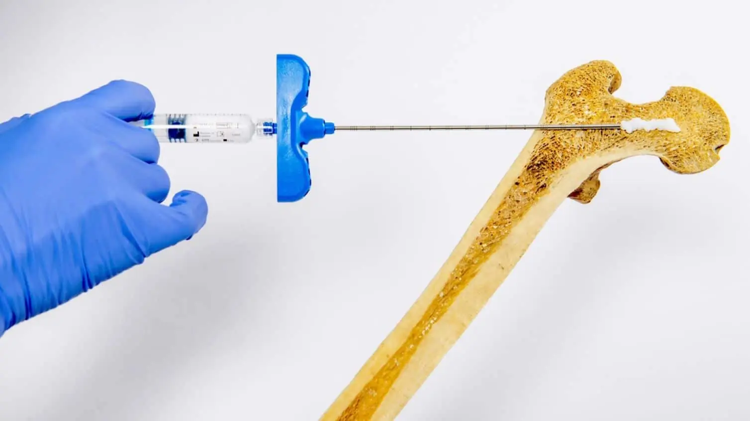 Breakthrough Injectable Hydrogel for Bone Density and Osteoporosis Treatment