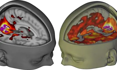 Revolutionary LSD Brain Scan Reveals How the Psychedelic Impacts Consciousness and Mental Health