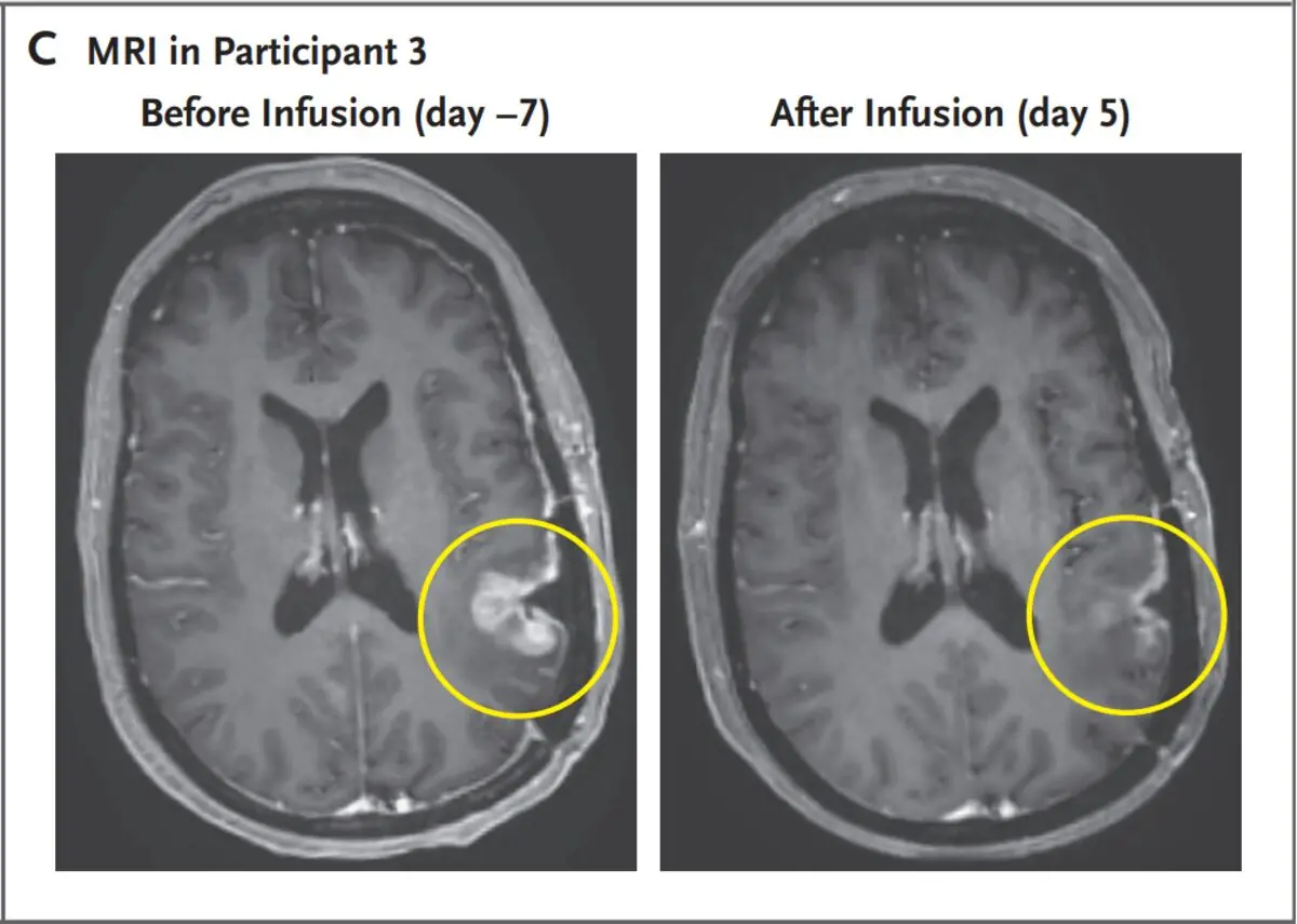 Breakthrough Brain Canc3r Treatment Shows Rapid Tumor Shrinkage with Single Dose