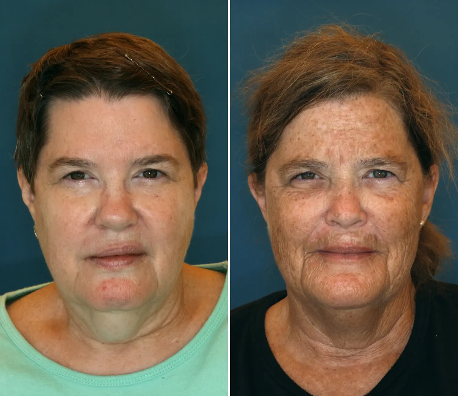 The Impact of Sm0king and Tanning on Aging: Twin Study Reveals Truth