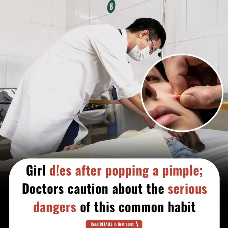 Girl d!es after popping a pimple; Doctors caution about the serious dangers of this common habit