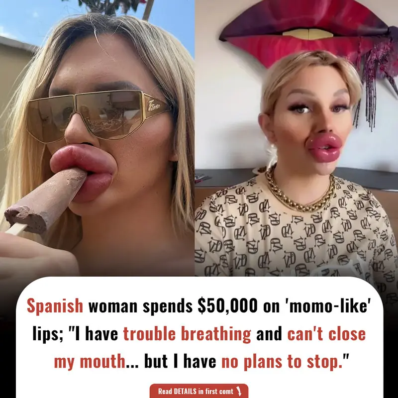 Spanish woman spends $50,000 crore on 'momo-like' lips; "I have trouble breathing and can't close my mouth... but I have no plans to stop"