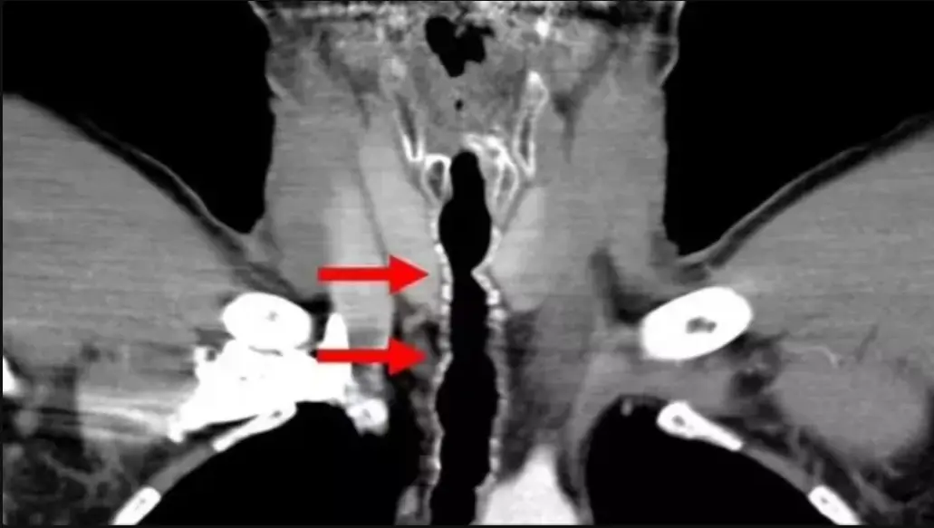 Sh0cking Health Impact of Sm0king: Chronic Cough, Hair Growth in Thr0at, and More