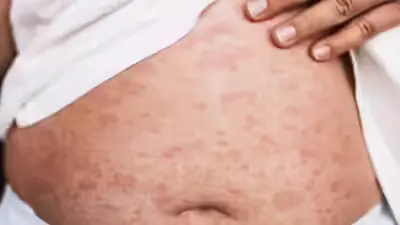 Measles Cases at 25-Year High: Symptoms, Risks, and Prevention Tips
