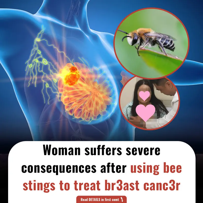 Woman suffers severe consequences after using bee stings to treat breast canc3r