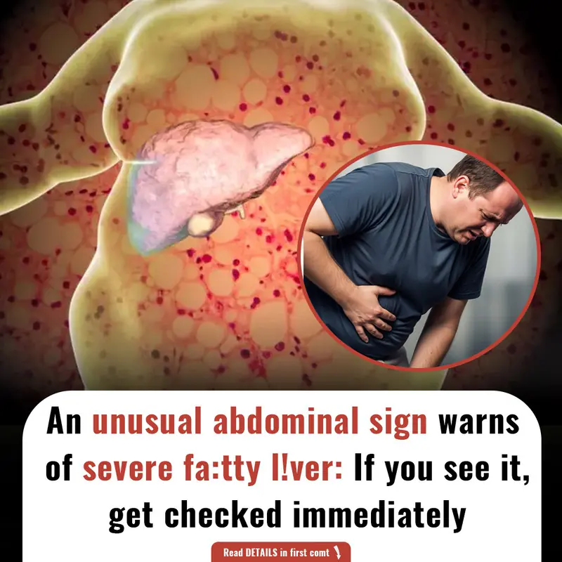 An unusual abdominal sign warns of severe fa:tty l!ver: If you see it, get checked immediately.